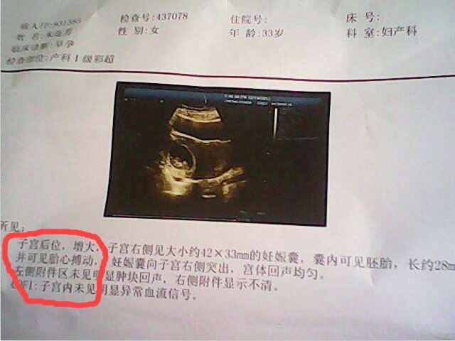 韵心公司教你怎么看孕期B超单